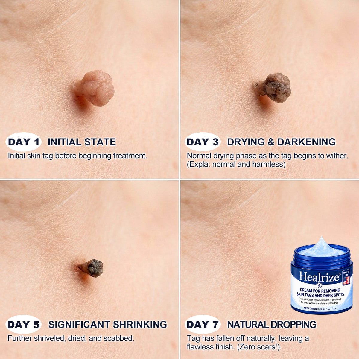 𝐇𝐞𝐚𝐥𝐫𝐢𝐳𝐞® 𝟕-𝐃𝐚𝐲 𝐒𝐤𝐢𝐧 𝐓𝐚𝐠 & 𝐒𝐩𝐨𝐭 𝐄𝐫𝐚𝐬𝐞𝐫 𝐂𝐫𝐞𝐚𝐦 (𝐙𝐞𝐫𝐨 𝐏𝐚𝐢𝐧, 𝐙𝐞𝐫𝐨 𝐒𝐜𝐚𝐫𝐬 𝐅𝐨𝐫𝐦𝐮𝐥𝐚)💎💎