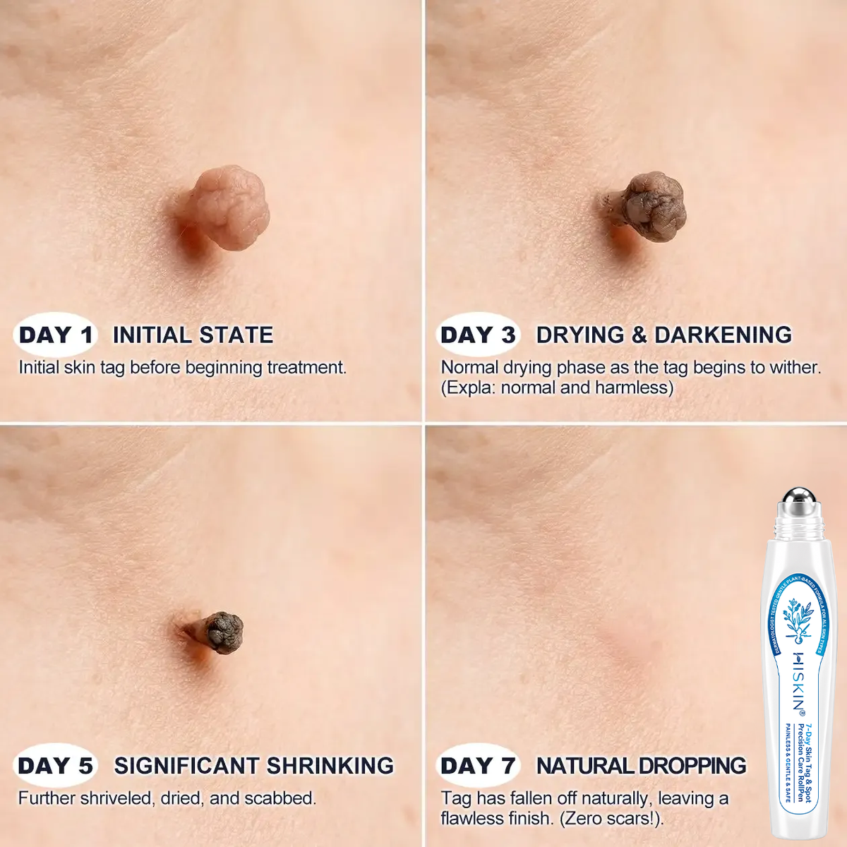 𝖧𝖨𝖲𝖪𝖨𝖭®👩‍⚕️⭐ 𝟕-𝐃𝒂𝘆 𝐒𝗸𝐢𝐧 𝐓𝒂𝗴 & 𝐒𝐩𝙤𝐭 𝐄𝐫𝒂𝐬𝙚𝐫 Painless & Scar-Free Advanced Imperfection Removal Rollerball Pen💎