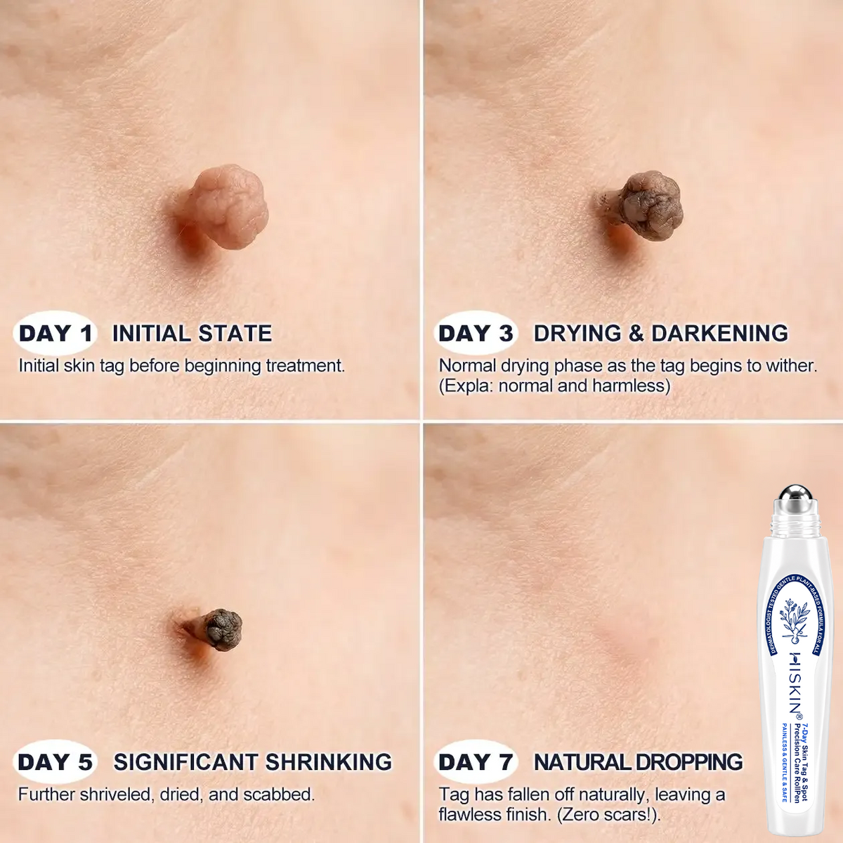 𝐇𝐈𝐒𝐊𝐈𝐍®👩‍⚕️ 𝟕-𝐃𝒂𝘆 𝐒𝗸𝐢𝐧 𝐓𝒂𝗴 & 𝐒𝐩𝙤𝐭 𝐄𝐫𝒂𝐬𝙚𝐫 Painless & Scar-Free Advanced Imperfection Removal Rollerball Pen🎀