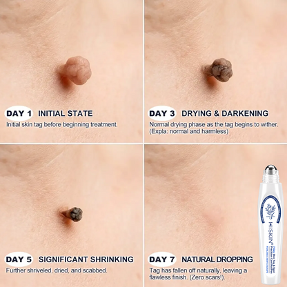 𝐇𝐈𝐒𝐊𝐈𝐍®👩‍⚕️ 𝟕-𝐃𝒂𝘆 𝐒𝗸𝐢𝐧 𝐓𝒂𝗴 & 𝐒𝐩𝙤𝐭 𝐄𝐫𝒂𝐬𝙚𝐫 Painless & Scar-Free Advanced Imperfection Removal Rollerball Pen🎀