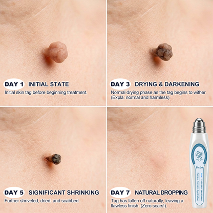 𝐏i𝐜𝐝o®7-𝐷𝑎𝑦 𝗧𝐚𝐠 & 𝗦𝗽𝐨𝐭 𝐄𝐫𝒂𝒔𝒆𝒓(Zero Pain, Zero 𝐒𝐜𝐚𝒓𝒔 Rollerball)⚡⚡